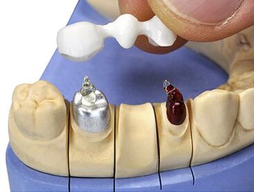Fixation Gels