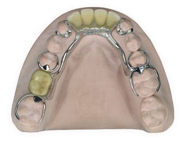 Partial Denture Alloy