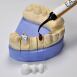Gel de fixation Standard pour Céramique et Zircone 2 ml