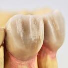 Dental Crown Waxes for Labs