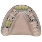 NEM 360 Base Metal Partial Denture Alloy 1 kg